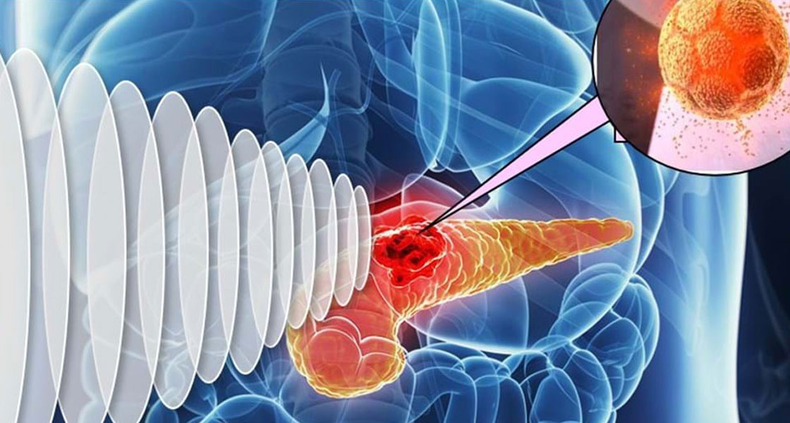 Early Cancer Detection
